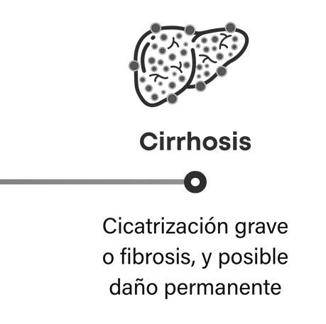Cómo progresa la NASH: la cirrosis es una fibrosis o cicatrización grave que puede provocar un posible daño permanente