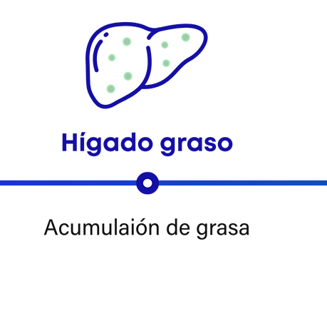 Cómo progresa la NASH: hígado graso tiene acumulación de grasa