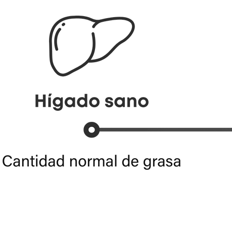 Cómo progresa la NASH: el hígado sano tiene una cantidad normal de grasa