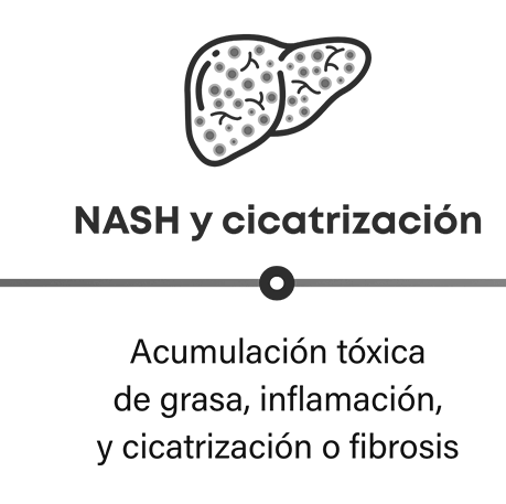Cómo progresa la NASH: la NASH y la cicatrización en el hígado pueden causar acumulación de grasa tóxica, inflamación y formación de tejido cicatricial o fibrosis.