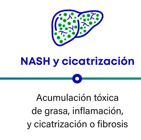 Cómo progresa la NASH: la NASH y la cicatrización en el hígado pueden causar acumulación de grasa tóxica, inflamación y formación de tejido cicatricial o fibrosis.