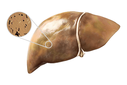 Fatty liver zoom in image