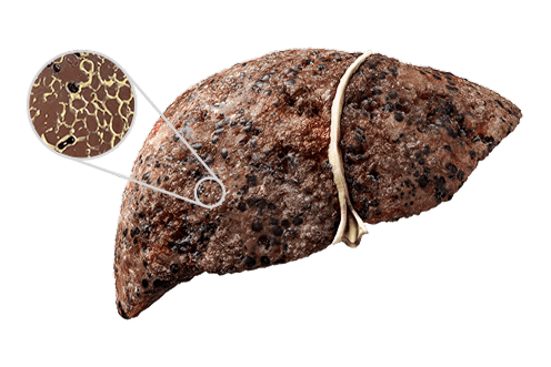 Liver with cirrhosis zoom in image