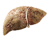 Liver with MASH and scarring image