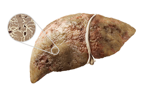 Liver with MASH and scarring zoom in image