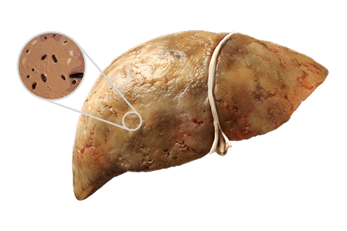 Liver with MASH zoom in image